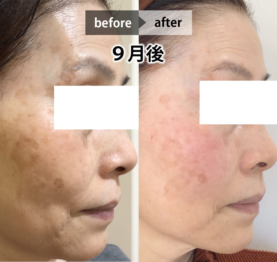 フェイシャル画像 5